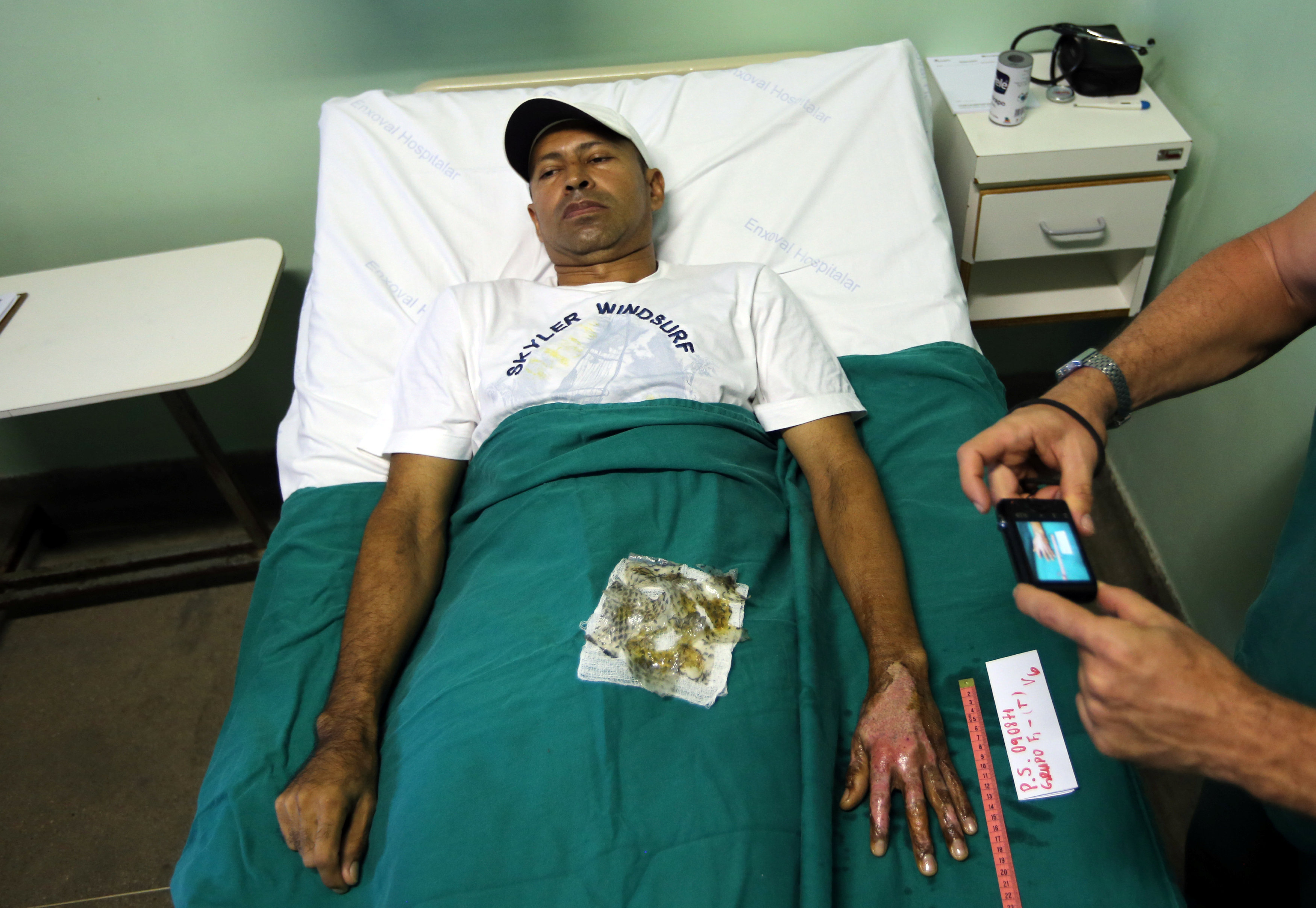 2017-05-25T140415Z_1679325683_RC19BA69BD00_RTRMADP_3_HEALTH-BRAZIL-BURNS
