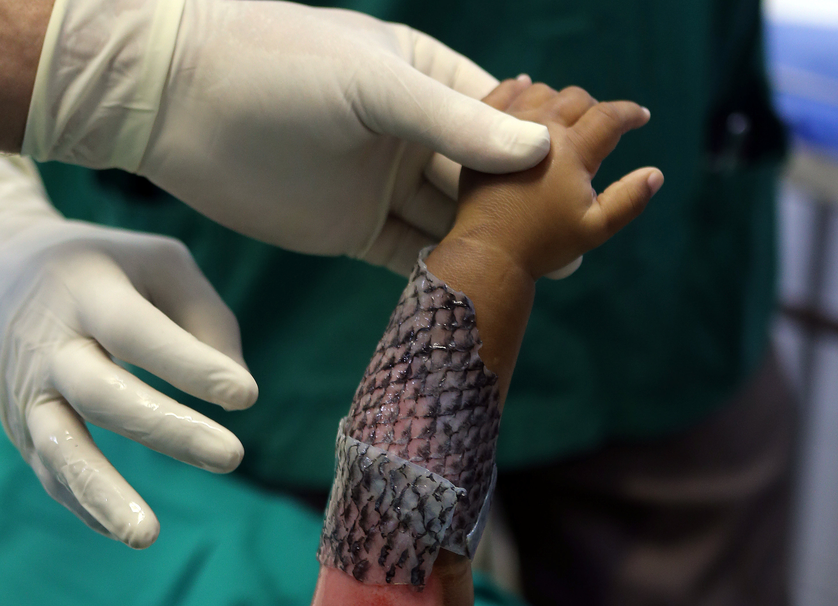 2017-05-25T140347Z_654342185_RC173593D550_RTRMADP_3_HEALTH-BRAZIL-BURNS (1)