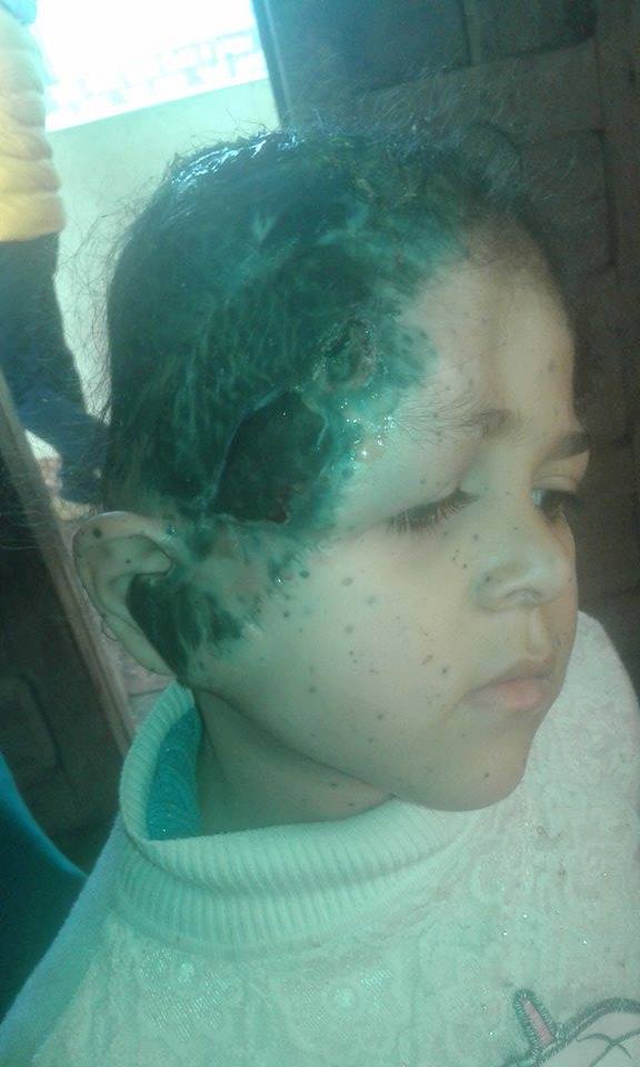 ولاء طفلة مصابة بتجمع دموى (2)
