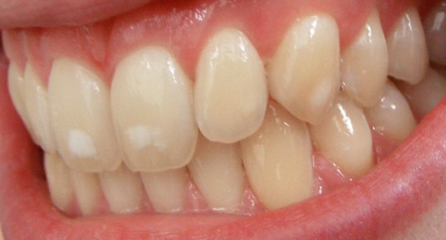 البقع البيضاء على الأسنان