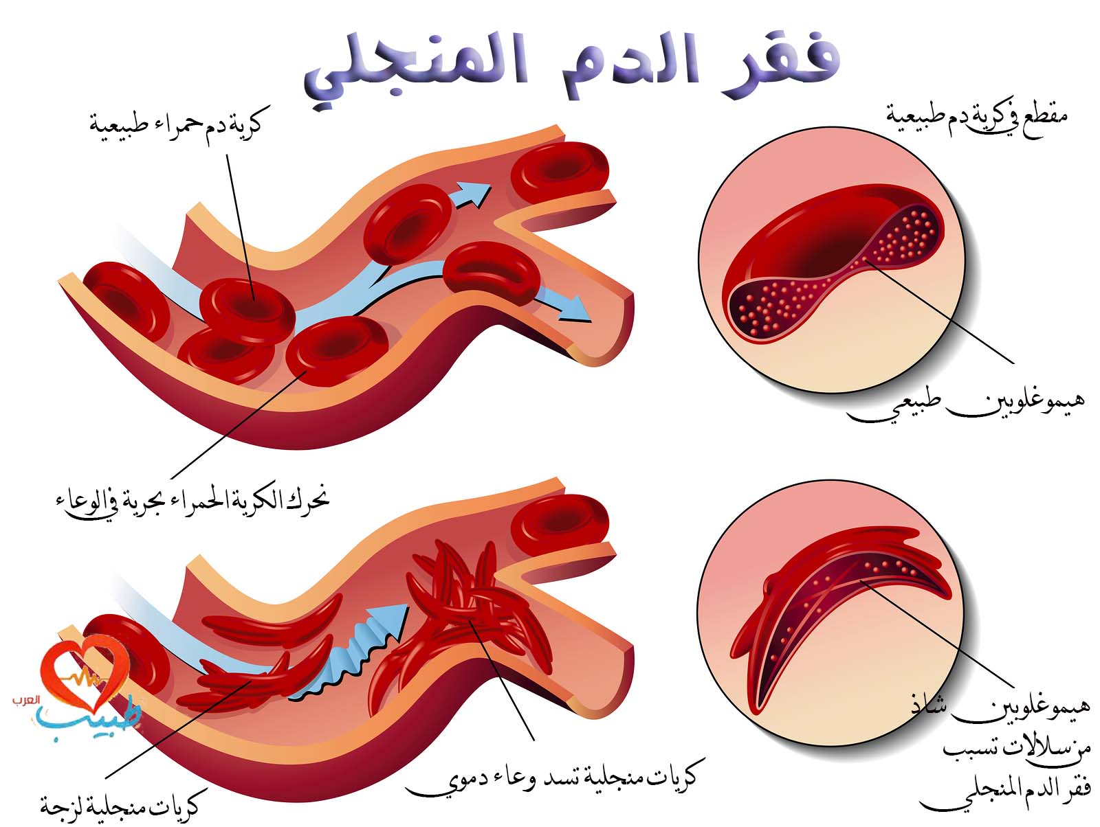 الانيميا المنجلية