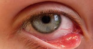 التهاب العيون