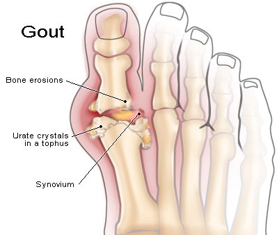 gout-8