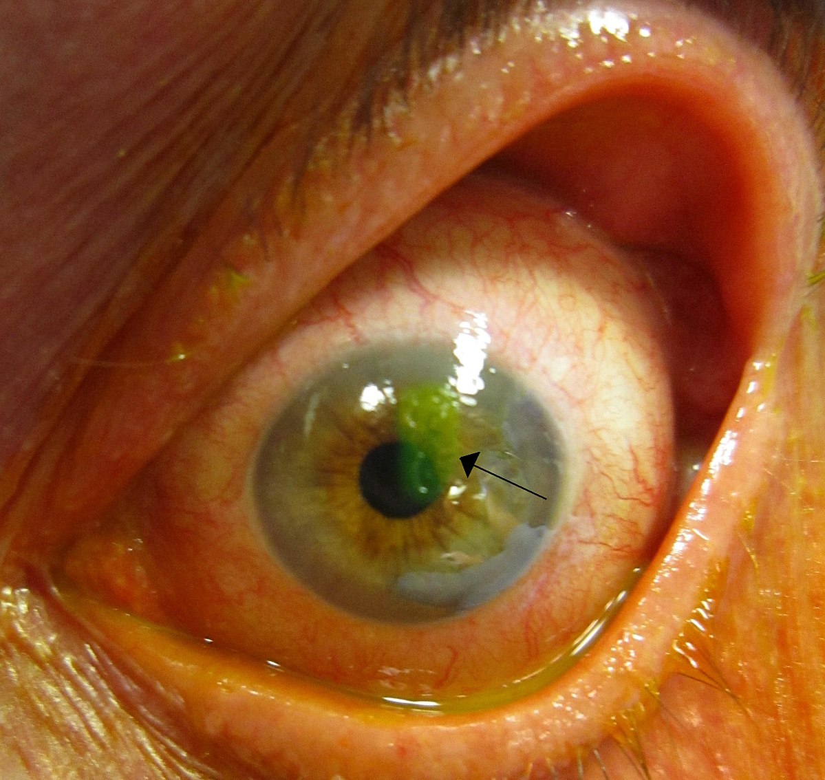 1200px-Human_cornea_with_abrasion_highlighted_by_fluorescein_staining