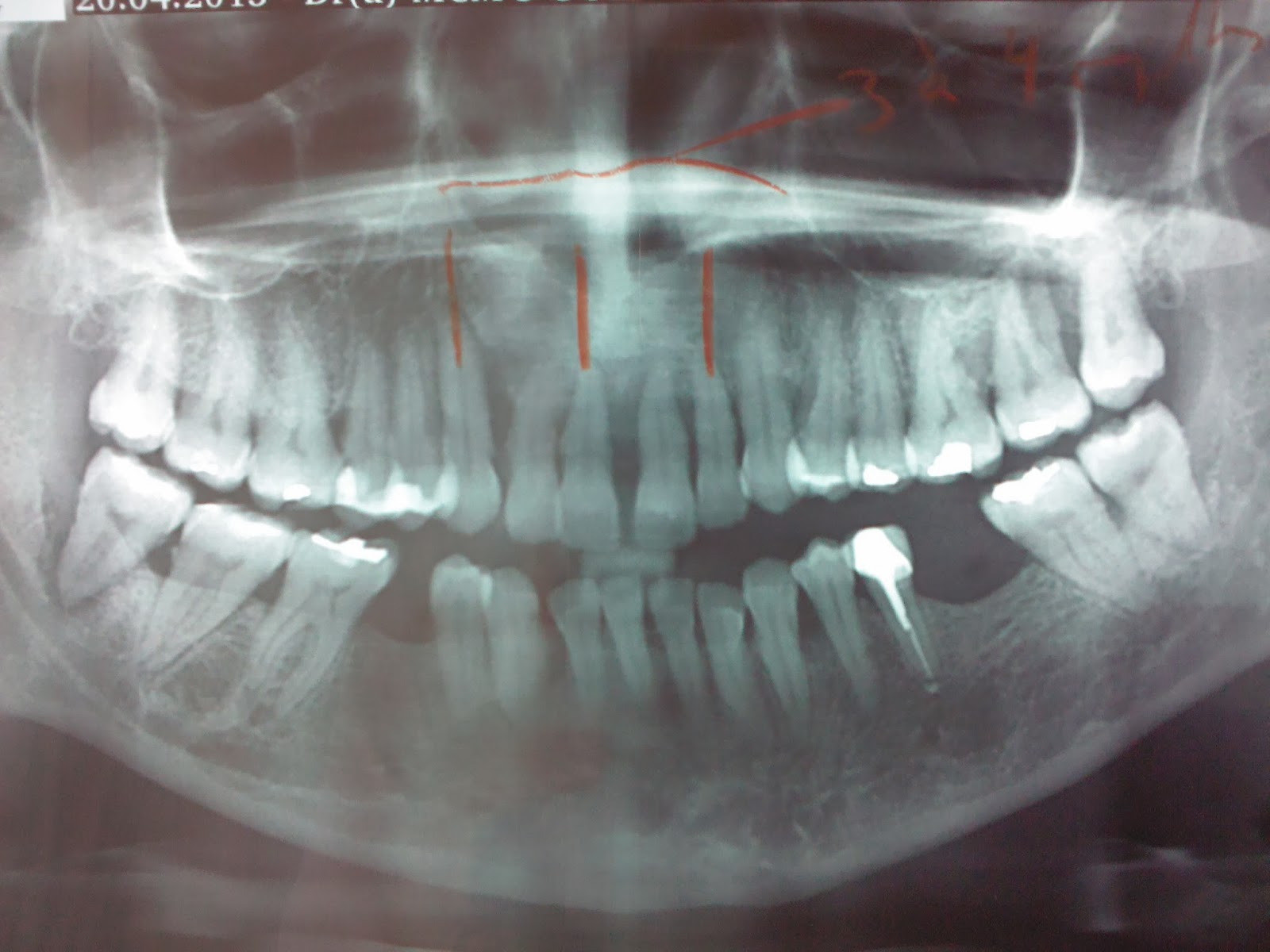 جزء من أدوات الكشف تعرف على أنواع وفوائد أشعة البانوراما للأسنان صوت الأمة
