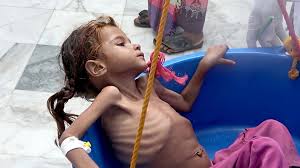 المجاعة فى اليمن