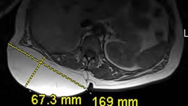 ورم ضخم على شكل «ثدى» ينمو على ظهر سيدة  