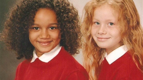 بالصور.. أغرب توأم في العالم