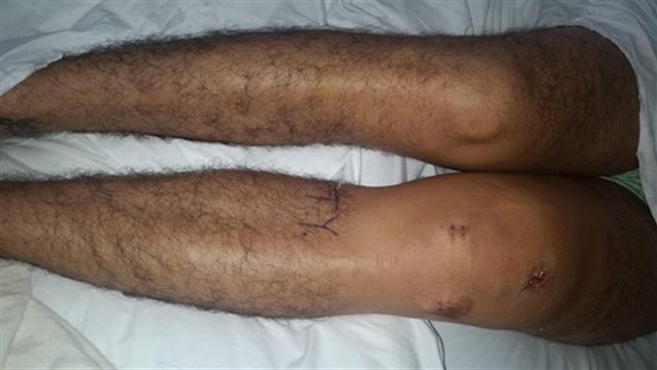 بالصور.. نجار يصيب ركبته بمسدس المسامير