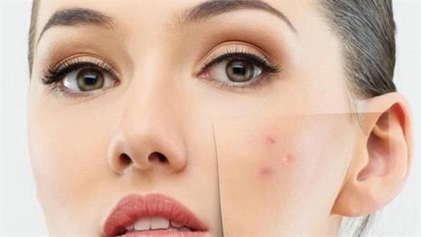 تخلصي من حب الشباب بالزعتر تخلصي من حب الشباب بالزعتر