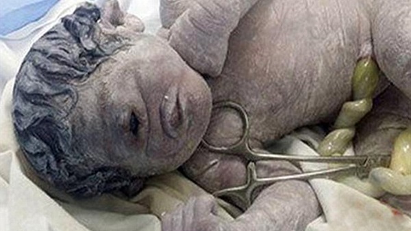 بالصورة.. طفل يولد بعينٍ واحدة وبدون أنف بالصورة.. طفل يولد بعينٍ واحدة وبدون أنف