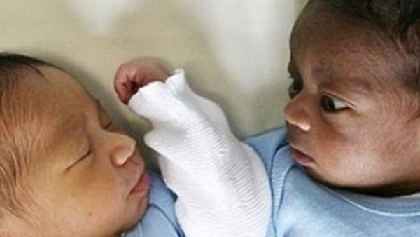 بالصورة.. توأمتان ببشرة مختلفة