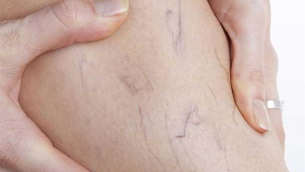 6 حيل للتخلص من الدوالي 6 حيل للتخلص من الدوالي