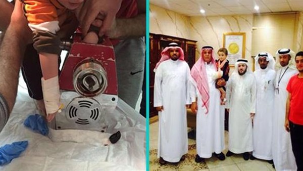 7 ساعات لإنقاذ طفل دخلت يده في فرامة لحم