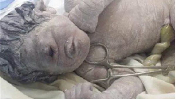 وفاة الرضيع صاحب «العين الواحدة»  بعد ساعات من ولادته 