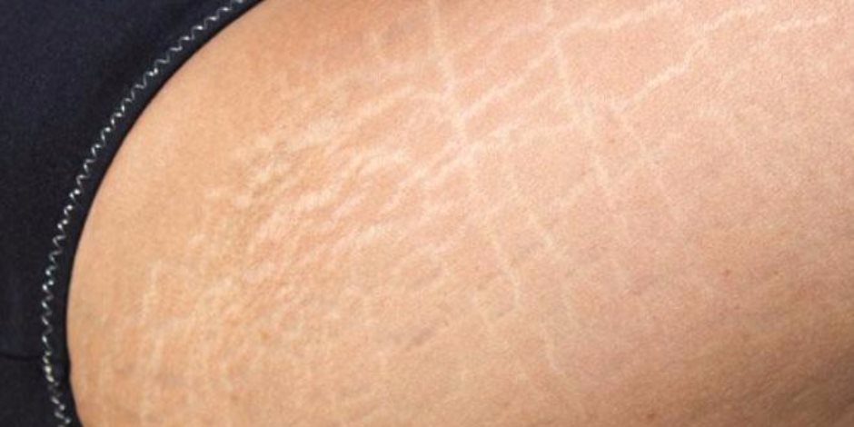 3 طرق علاج منزلية تمكنك من التخلص من علامات تمدد الجلد