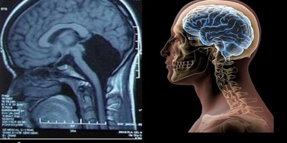 أمريكيون يتوصلون لاكتشاف مذهل حول المخ قد يمهد لعلاج الزهايمر والتوحد