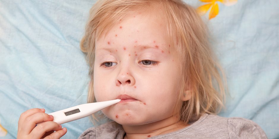 الوقاية خير من العلاج.. دليلك لحماية طفلك من الإصابة بفيروس الحصبة