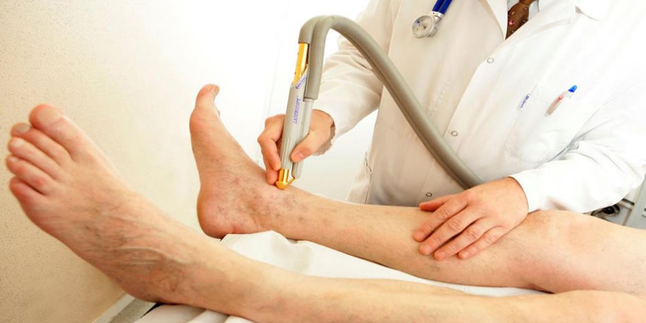 الإصابة بدوالي الساق قد يزيد من احتمالات لجلطات الدموية