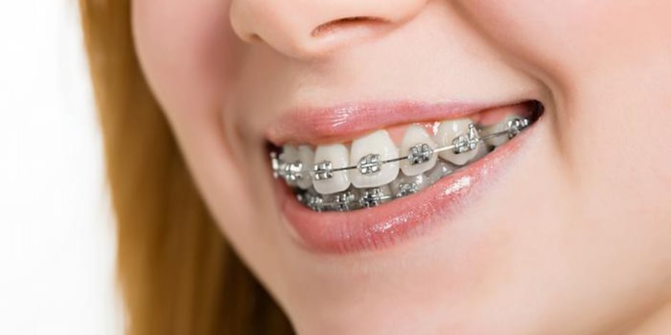 متى نلجأ إلى تكسير الفك وتعديل الأسنان بالجراحة؟