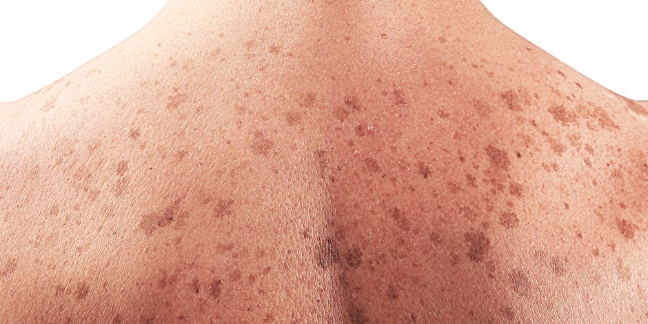  علاج التهاب المفاصل قد تشكل أملا جديدا لعلاج سرطان الجلد 