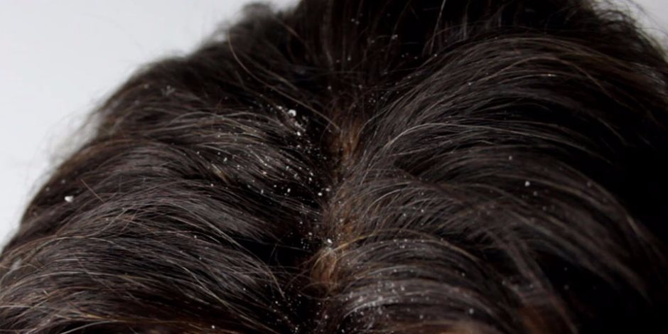 3 طرق لعلاج قشرة الشعر بالمنزل.. السر في الخل