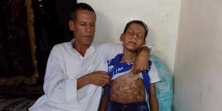 "محمد".. دخل المستشفى بارتفاع في الحرارة فخرج مصابا بجدري مائي (صور)
