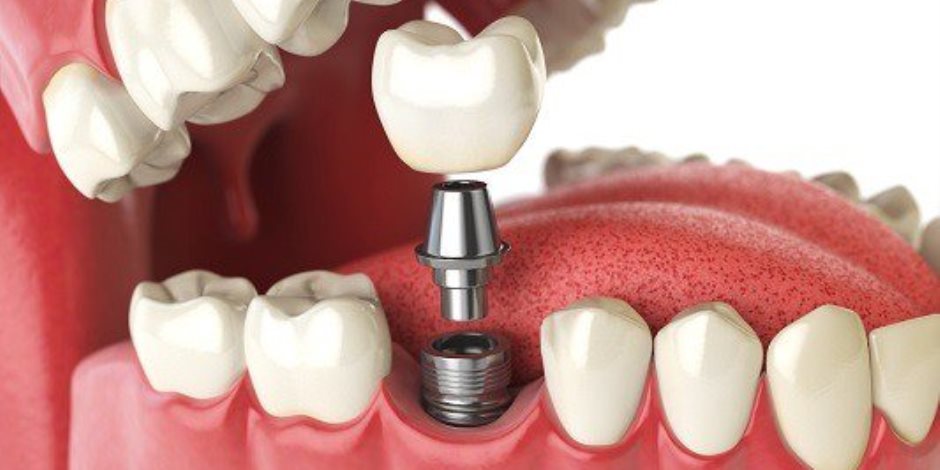 تقنية جديدة لزرع الأسنان بدون عملية جراحية