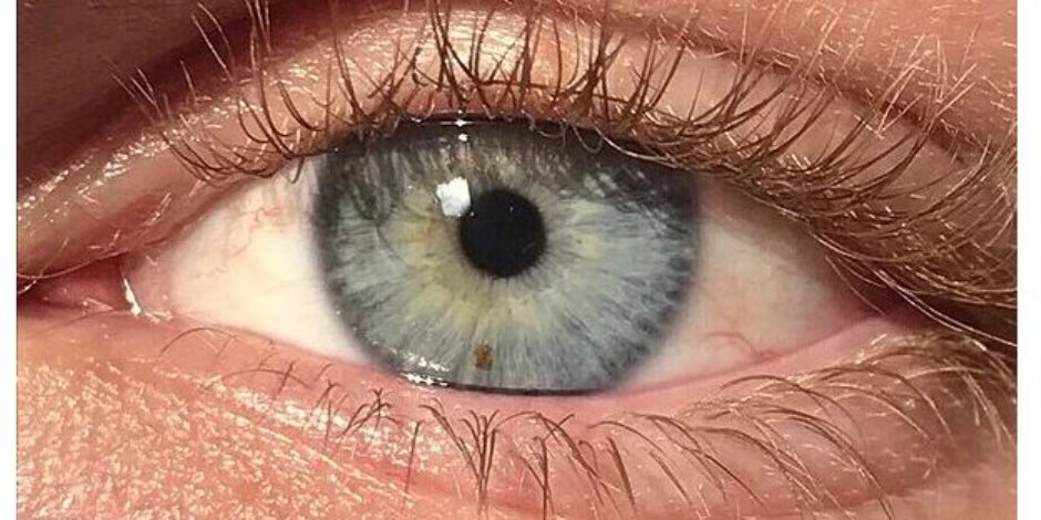 البقع الصفراء تحت شبكية العين علامة تحذيرية للإصابة المبكرة بالألزهايمر 