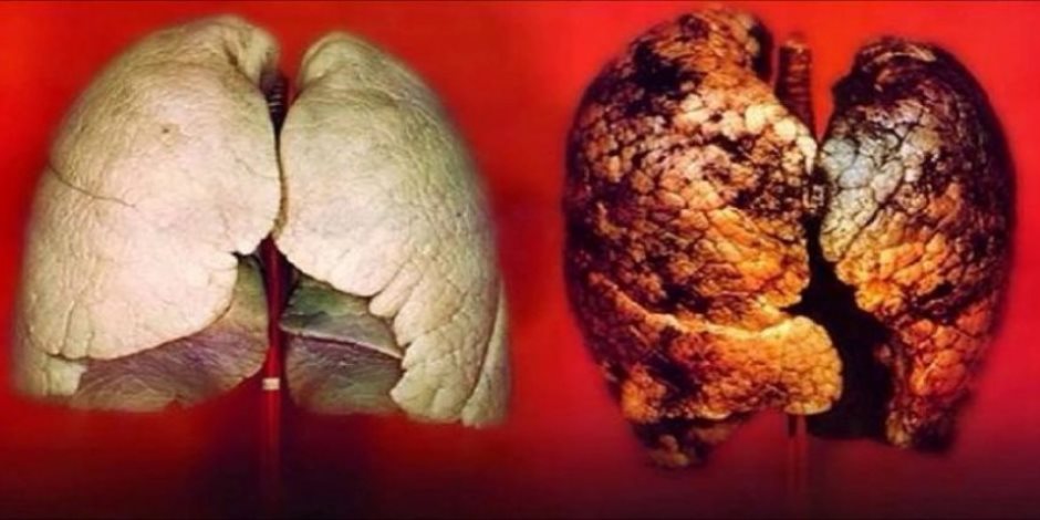 التلوث وفقدان الوزن وضيق التنفس وأسباب أخرى تصيب غير المدخنين بسرطان الرئة
