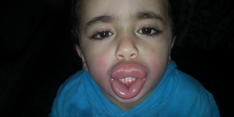  تورم وجه طفل لتناوله مادة غذائية منتهية الصلاحية بكفر الشيخ  