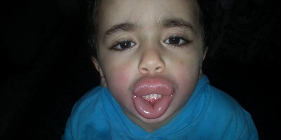 شيبسي بالنمل ..تورم وجه طفل لتناوله مادة غذائية منتهية الصلاحية بكفر الشيخ  