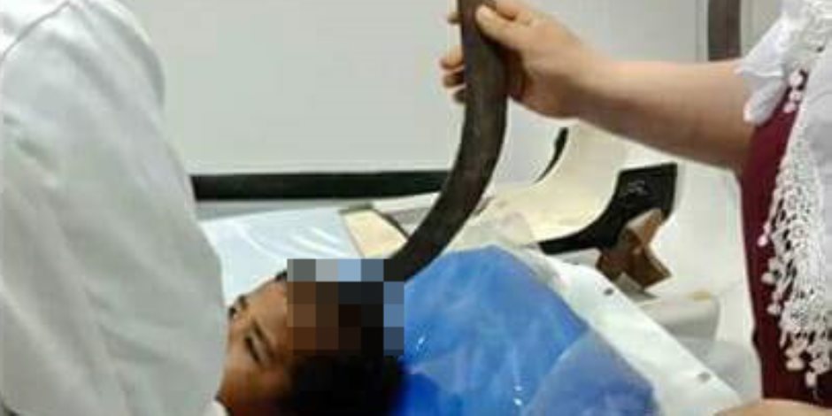 فريق طبي ينجح فى إنقاذ حياة طفل دخل في رأسه «منجل» زراعي بدمياط (صورة)