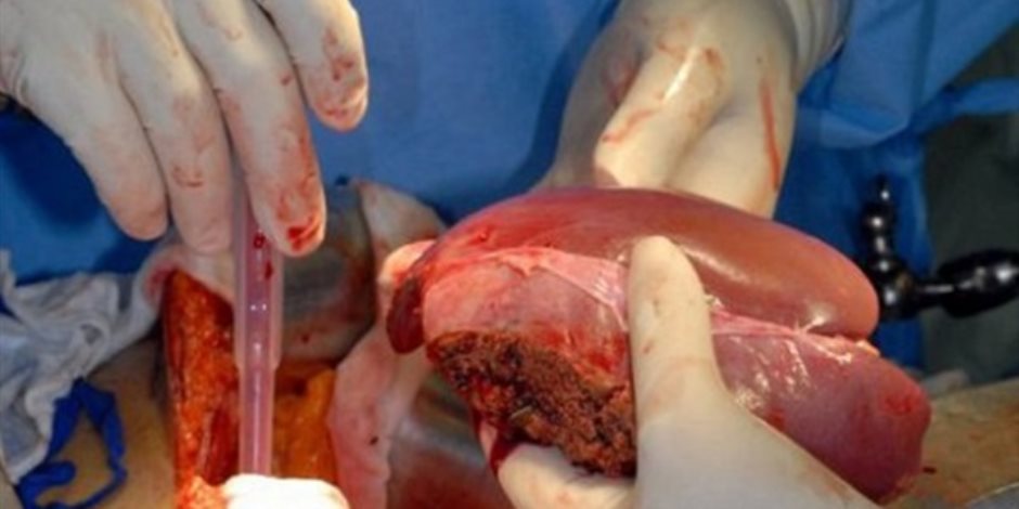 1500 عملية غير قانونية سنويا.. لماذا أثارت إعلانات «تجارة الأعضاء» غضب الأطباء؟