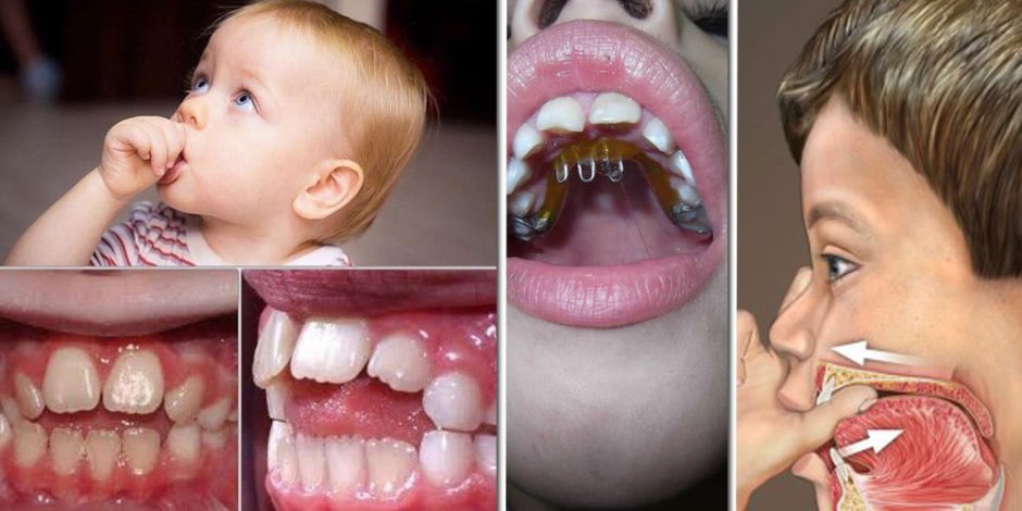 تسبب تشوه الأسنان وصعوبات الكلام.. كيف نتخلص من عادة مص الأصابع عند الأطفال؟