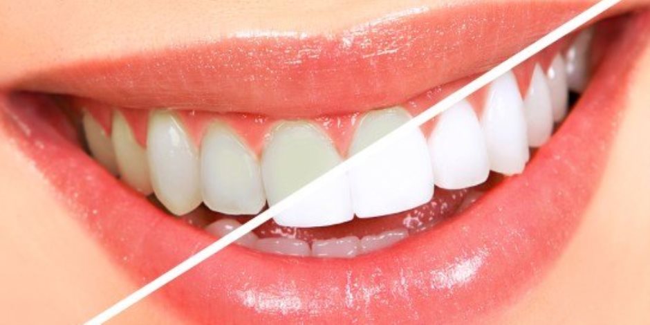 طريقة لعلاج اصفرار الأسنان بوصفة طبيعية في المنزل