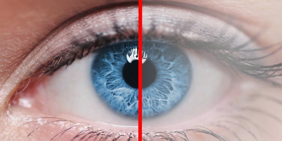 المياه البيضاء على العين تؤدي لفقدان البصر.. ما هي طرق الوقاية منها؟
