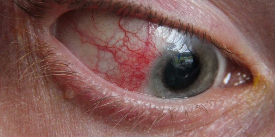 هل تعاني من التهاب العين؟.. تعرف على الأسباب وطرق الوقاية ...