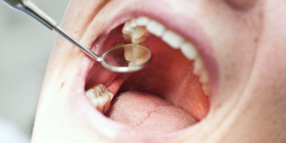علامات إذا ظهرت على أسنانك فأنت مصاب باضطراب المعدة أو الزهايمر