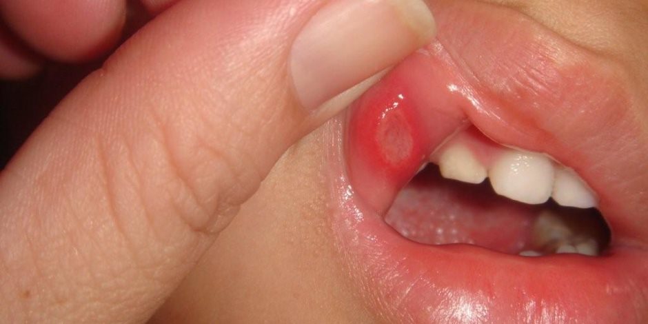 هل تعاني من الإصابة ببقع بيضاء في فمك؟.. احذر قد تكون مصاب بالقلاع الفموى