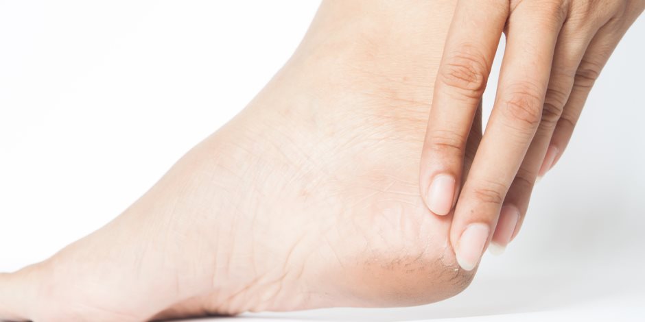 إزالة الجلد الميت أبرزها.. 6 أسباب لتشقق كعوب القدمين