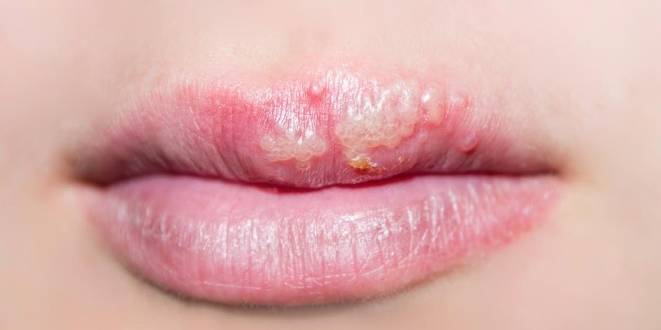 علاج قرح الفم في ساعات السر في الثوم والألوفيرا صوت الأمة