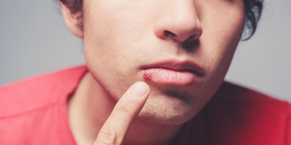 علاقة قروح الفم أو الأعضاء التناسلية بأعراض الهربس 