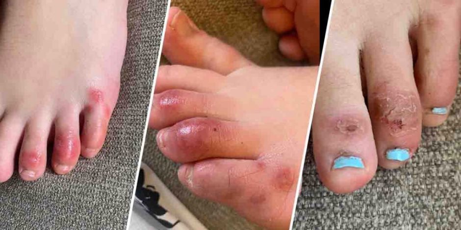 مخاوف من أعراض جديدة لكورونا تبدأ بتورم الأصابع.. دراسة: لا يمكن استبعاد ذلك