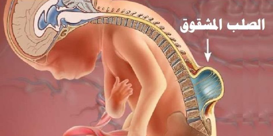 ما هو مرض الصلب المشقوق.. بعد حالة زوجي الهانوفيل ما هو مرض الصلب المشقوق.. بعد حالة زوجي الهانوفيل