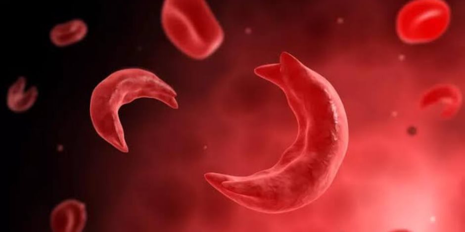 في اليوم العالمي لفقر الدم المنجلي.. تعرف على أعراضه وطرق علاجه؟