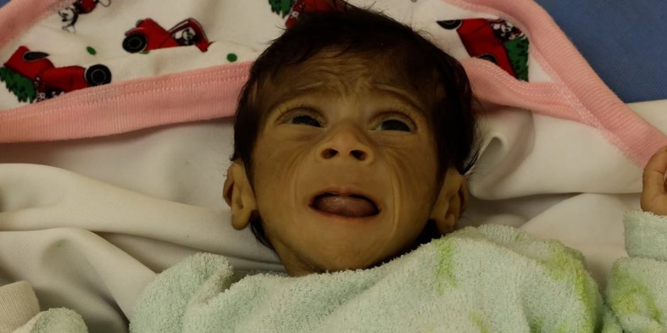 289 شهيدا بينهم 115 طفلا ضحايا المجاعة وسوء التغذية فى غزة.. واليونيسيف تحذر : شاهدنا أطفال بأجساد هزيلة ضعفاء لا يستطيعون البكاء أو الأكل 289 شهيدا بينهم 115 طفلا ضحايا المجاعة وسوء التغذية فى غزة.. واليونيسيف تحذر : شاهدنا أطفال بأجساد هزيلة ضعفاء لا يستطيعون البكاء أو الأكل