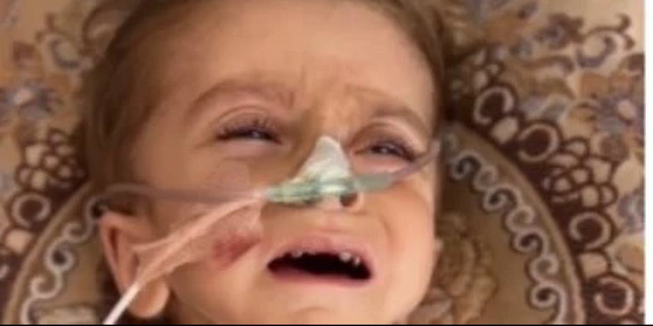 مأساة الطفل كريم معمر.. سوء التغذية يتسبب في تضخم بالكبد ولا أدوية بمستشفيات غزة