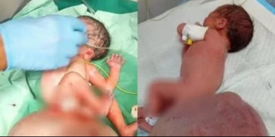 رضيعة فى غزة تصاب بتشوه خلقي لاستنشاق الأم غازات سامة