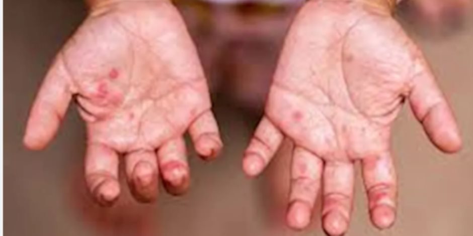 التفاصيل الكاملة لظهور فيروس HFMD بين عدد من طلاب مدرسة فى الجيزة